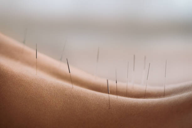Acupuncture in Atitlan 6